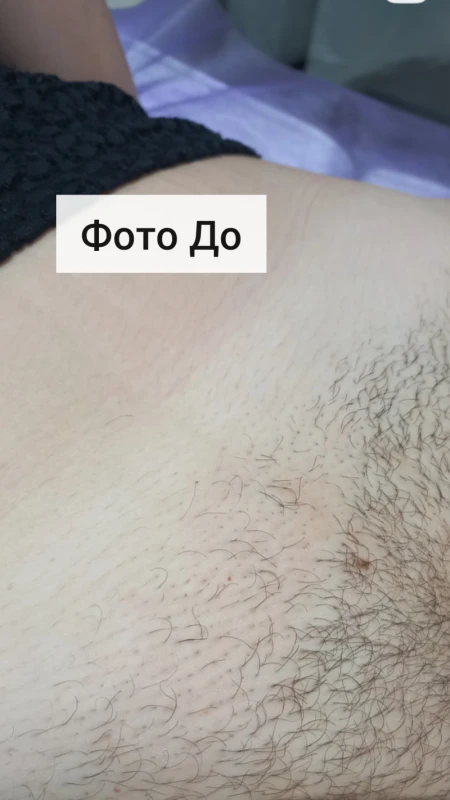 Фото з портфоліо Електроепіляція та шугаринг
