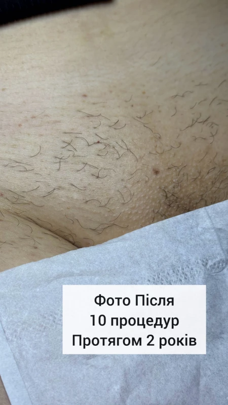 Фото 2 з портфоліо Електроепіляція та шугаринг