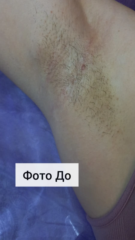 Фото 3 з портфоліо Електроепіляція та шугаринг
