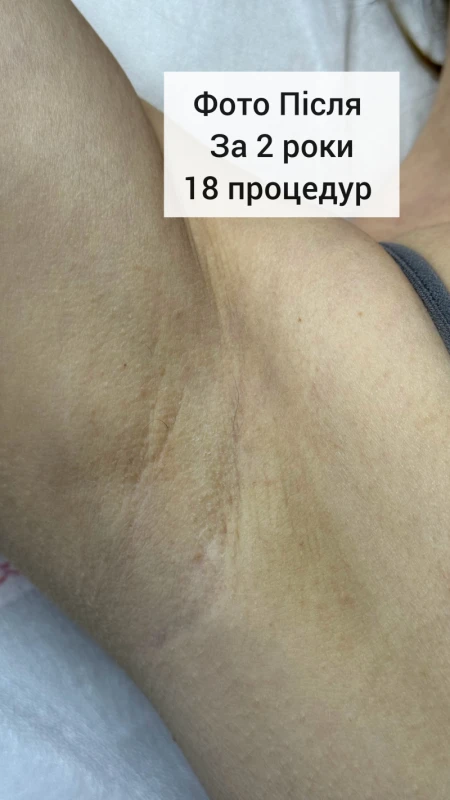 Фото 4 з портфоліо Електроепіляція та шугаринг