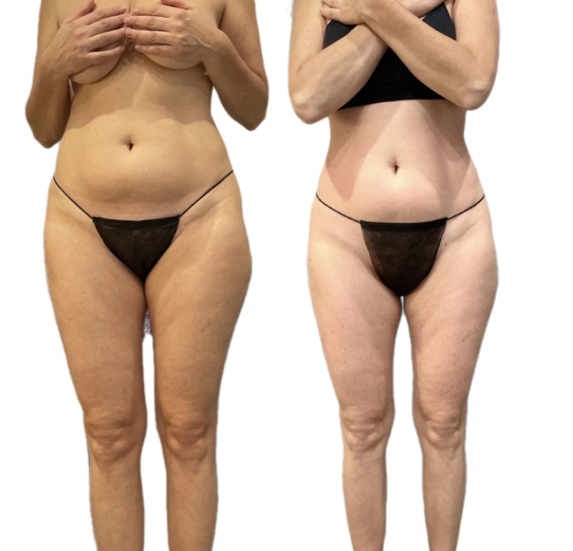Фото 5 из портфолио BodySculpt Hub