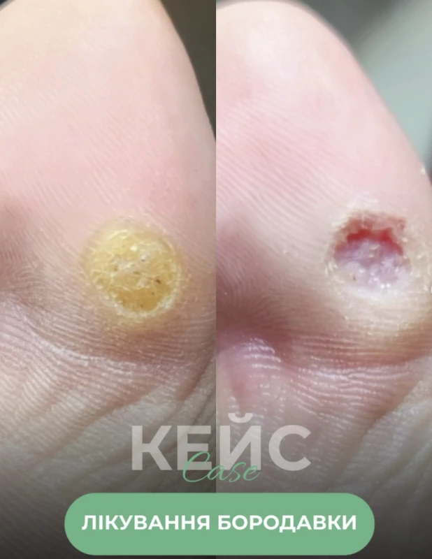 Фото 3 з портфоліо Студія подології Яни Соболь